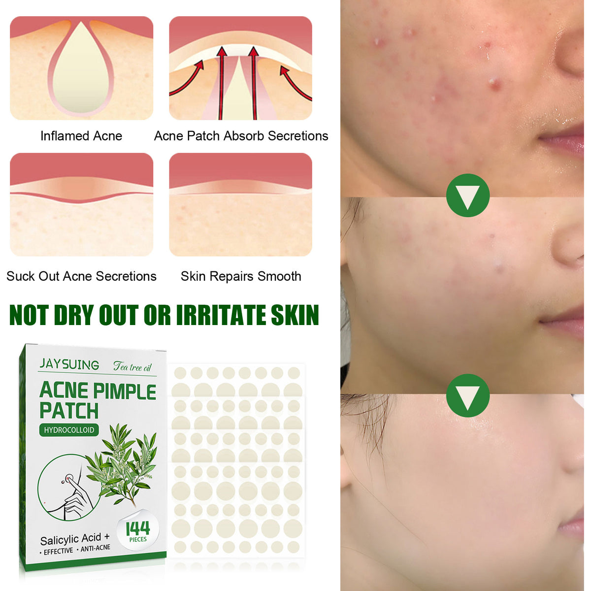 How to use pimple patches